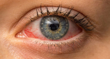 Kırmızı göz hastalığı olarak bilinen konjonktivit nedir, belirtileri nelerdir, nasıl tedavi edilir? Konjonktiva tümörleri ve çeşitleri