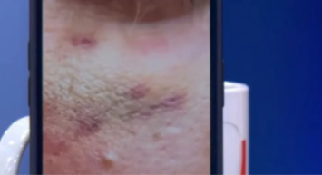 Kolunda ısırık izi yüzde morluk!