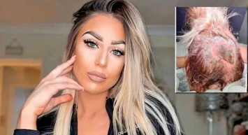 Kuaförde saçını boyattı, derisini kaybetti!