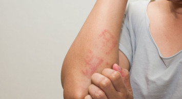 Kurdeşene İyi Gelen Doğal Tedaviler