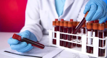 Lipaz değeri neden yükselir? Lipaz değerinin yüksek olmasını etkileyen faktörler