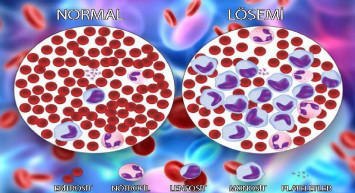 Lösemi nedir tedavisi nasıl olur? Löseminin belirtileri nelerdir? Kaç yaşlarında olur? Lösemi öldürür mü?