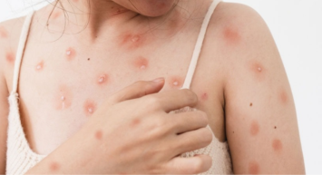 Maymun Çiçeği Virüsü'nün yeni varyantı ortaya çıktı