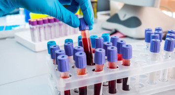 MCV Nedir, MVC Belirtileri Nelerdir?