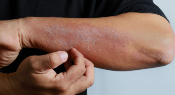 Mevsim Geçişlerinde Artan Alerjik Egzama Nasıl Önlenir?