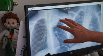 Nefes darlığı şikayetiyle hastaneye götürülmüştü: Çocuğun göğüs boşluğundan çıkan şey şok etti