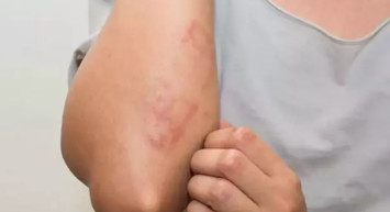 O Hastalık Türkiye'de Görüldü! Bazı Yerler Karantinaya Alındı