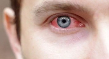 Okulların açılmasıyla birlikte adenovirüs vakalarında artış yaşandı!