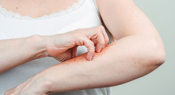 Pire Isırmasına Ne İyi Gelir? 