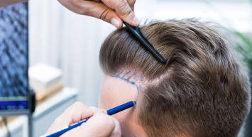 Profesyonel saç ekimi için nelere dikkat etmelisiniz?