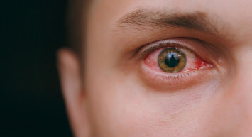 Retina Yırtılması Nedir, Retina Yırtılması Nasıl Tedavi Edilir?