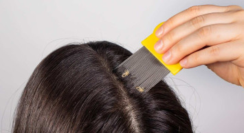 Saç kaşıntısı neden olur? Saç kaşıntısı nasıl geçer? Saç kaşıntısı  için evde doğal tedavi yöntemleri