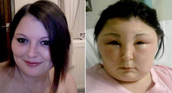 Saçını Boyadı: Kör Oldu! İyileşmesi Aylar Sürecek...