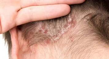 Saçta egzama belirtileri nelerdir? Hangi yiyecekler saçta egzama yapar? Egzama nasıl tedavi edilir?