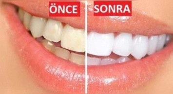 Sarı dişler nasıl beyazlatılır? Ev yapımı doğal ve bitkisel karışımlar ile sarı dişleri beyazlatma yöntemleri
