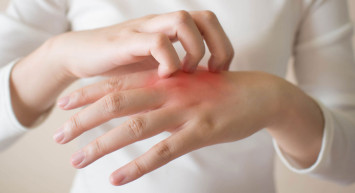 Sedef Hastalığı İçin Doğal Tedavi Yöntemleri