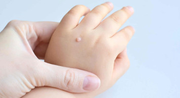 Siğil Nasıl Geçer?