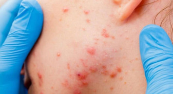 Sivilceleri geçmeyenler dikkat: Tiroid hastalığına sebep olabilir! Bir bardak suyla test yapabilirsiniz