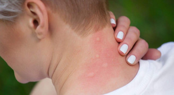 Sivrisinek ısırığı kaç günde geçer? Sivrisinek ısırığı  kaşıntısı nasıl geçer? Yaz aylarının korkulu rüyası sinek ısırığına 13 öneri