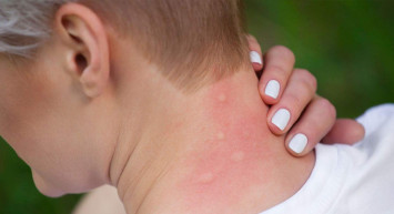 Sivrisinek ısırığı kaşıntısı nasıl geçirilir? Sivrisinek sokmasında kaşıntıyı geçirecek doğal yöntemler nelerdir? Sivrisinek ısırığı kaşıntısına iyi gelen doğal yöntemler