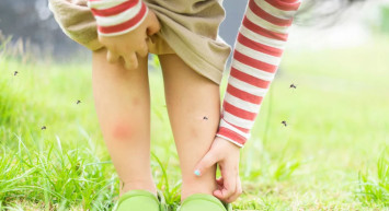 Sivrisinek Isırığı Nasıl Tedavi Edilir?