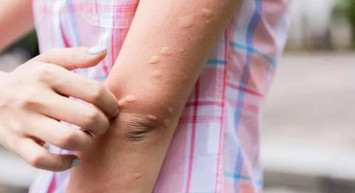 Sivrisinek ısırığı nasıl tedavi edilir? Sivrisinek ısırığı kaşıntısı nasıl giderilir?