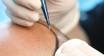 Smile Haır Clinic Uzman Doktoru Dr. Mehmet Erdoğan; Ütopik Sonuçlar Vaat Etmiyoruz