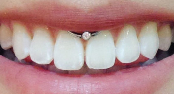 Smiley Piercing Zararları Nelerdir?