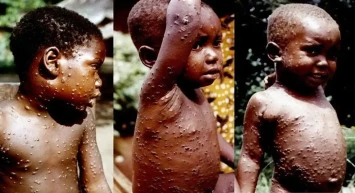 Son Dakika: Sağlık Bakanlığı'ndan M Çiçeği Virüsü ile İlgili Türkiye Raporu