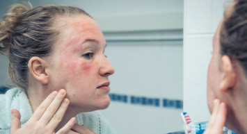 Stevens Johnson Sendromu Nedir?