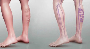 Tedavi edilmeyen Varisler ölümcül pıhtılara dönüşebilir!