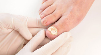 Tırnak mantarı neden olur, bulaşıcı mıdır? Tırnak mantarına ne iyi gelir? Tırnak mantarının 7 bitkisel çözümü 