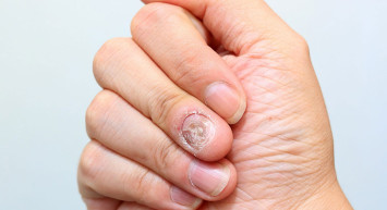 Tırnak tümörü nedir, belirtileri nelerdir, nasıl tedavi edilir?