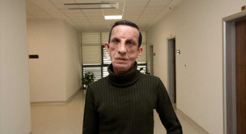 Türkiye'nin İlk Yüz Nakli Kutlandı