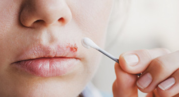 Uçuk neden çıkar, nasıl geçer, hangi hastalıkların belirtisidir? Evde uçuğu geçiren en hızlı çözümler