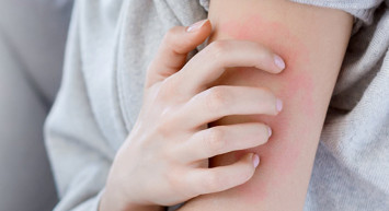 Uyuz Hastalığı Nedir?