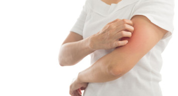 Uyuz Vakalarında Tedirgin Eden Artış!