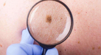 Vücutta yer alan benler tehlikeli mi? Vücutta yer alan her ben kanser yapar mı? Benler konusunda dikkat edilmesi gereken konular