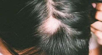 Will Smith’in karısının hastalığı Alopesi nedir? Alopecia sebepleri neler, neden olur, nasıl anlaşılır, tedavisi var mı?