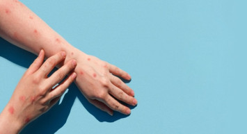 Yabancı Uyruklu Şahsa ''Maymun Çiçeği'' Testi Yapıldı: Sonuç Ne Çıktı?