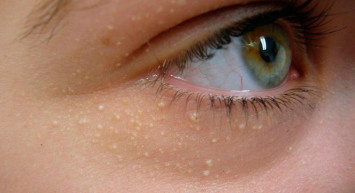 Yağ bezesi neden olur, nasıl geçer, nasıl alınır? Kanseri tetikleyen yağ bezeleri hakkında bilinmesi gerekenler 