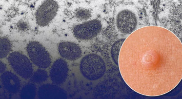 Yeni salgın vatandaşları paniğe sürükledi! Önce Avrupa, şimdi ABD sırada...