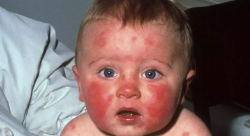 Yüzü kızaran çocuklara dikkat: "Beşinci hastalık" nedir? Belirtileri nelerdir?