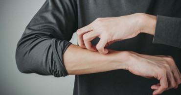 Aloe Vera Sedef Hastalığına İyi Gelir mi? İşte Sedefe İyi Gelen Doğal Yöntemler