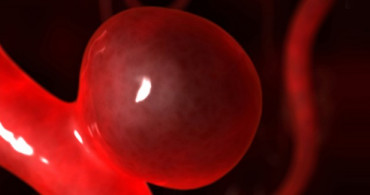 Aort Anevrizma Nedir?