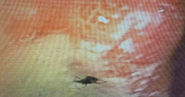 Aydın'da Karnına Giren Böcek Ameliyatla Çıkarıldı