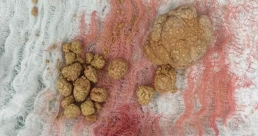 Bayburt'ta İki Hastanın Mesanesinden 27 Taş Çıkarıldı
