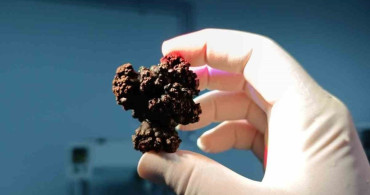 Bozyazı'da 4 santimetrelik mesane taşı tek parça halinde çıkarıldı