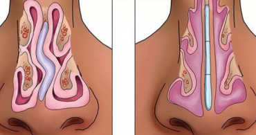 Burun Eti (Septum Deviasyonu) Nedir?