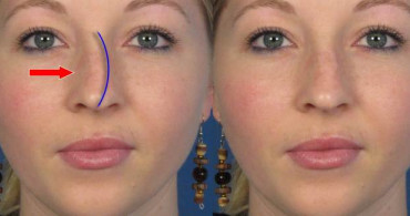 Burun Kemik Eğriliği (Septum Deviasyonu) Nedir?